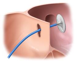 Deployment of the Amplatzer Atrial Septal Defect Occluder Step 1