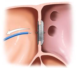Deployment of the Amplatzer Atrial Septal Defect Occluder Step 3
